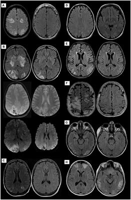 Posterior reversible encephalopathy syndrome post stem cell transplantation in sickle cell disease: case series and literature review